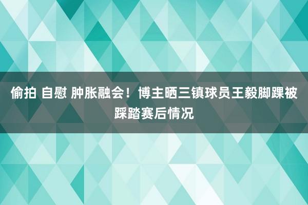 偷拍 自慰 肿胀融会！博主晒三镇球员王毅脚踝被踩踏赛后情况